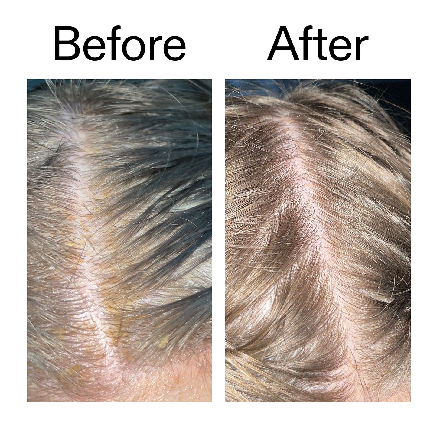 salicylic-acid-exfoliating-scalp-treatment-b2 Salicylic_Acid_Exfoliating_Scalp_Treatment_Before_After_2000x2000_e572a30f-057c-4a48-823b-1c09dc97f8d0.jpg