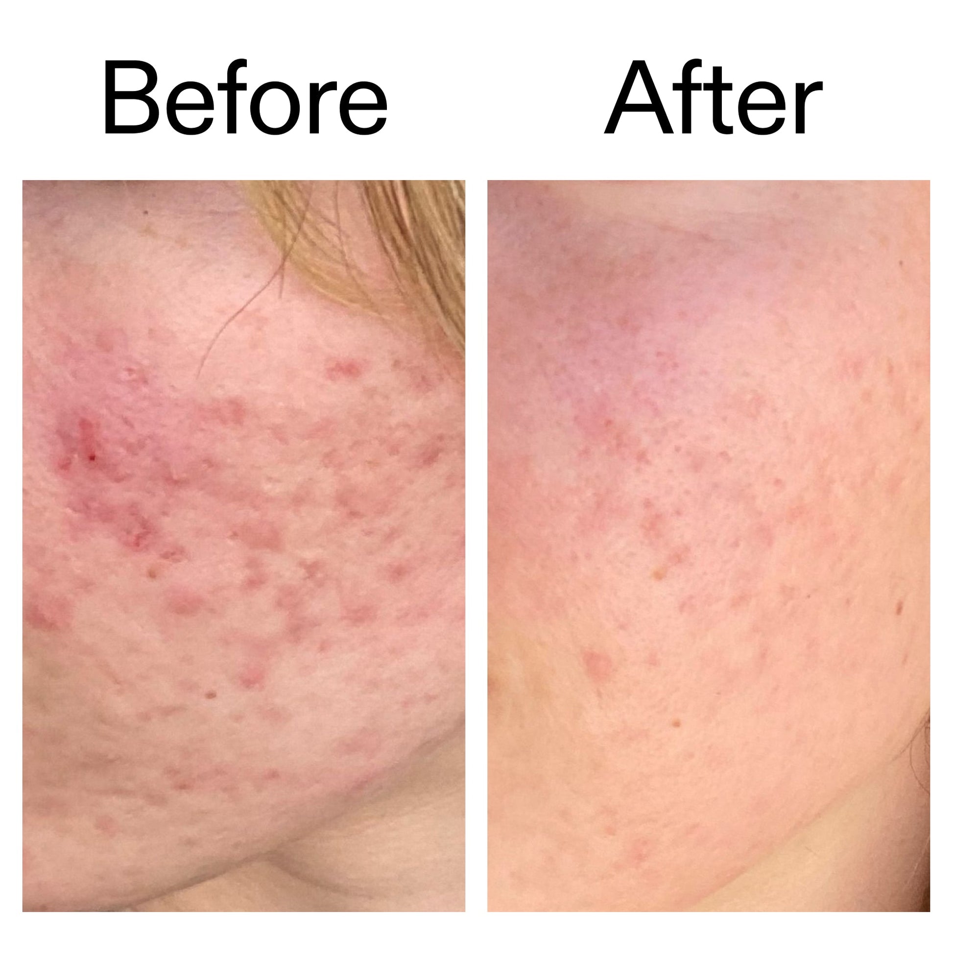10-azelaic-acid-serum-for-redness-relief-g1 Azealic_Acid_Serum_B_A_Ppage_2000_x_2000.jpg