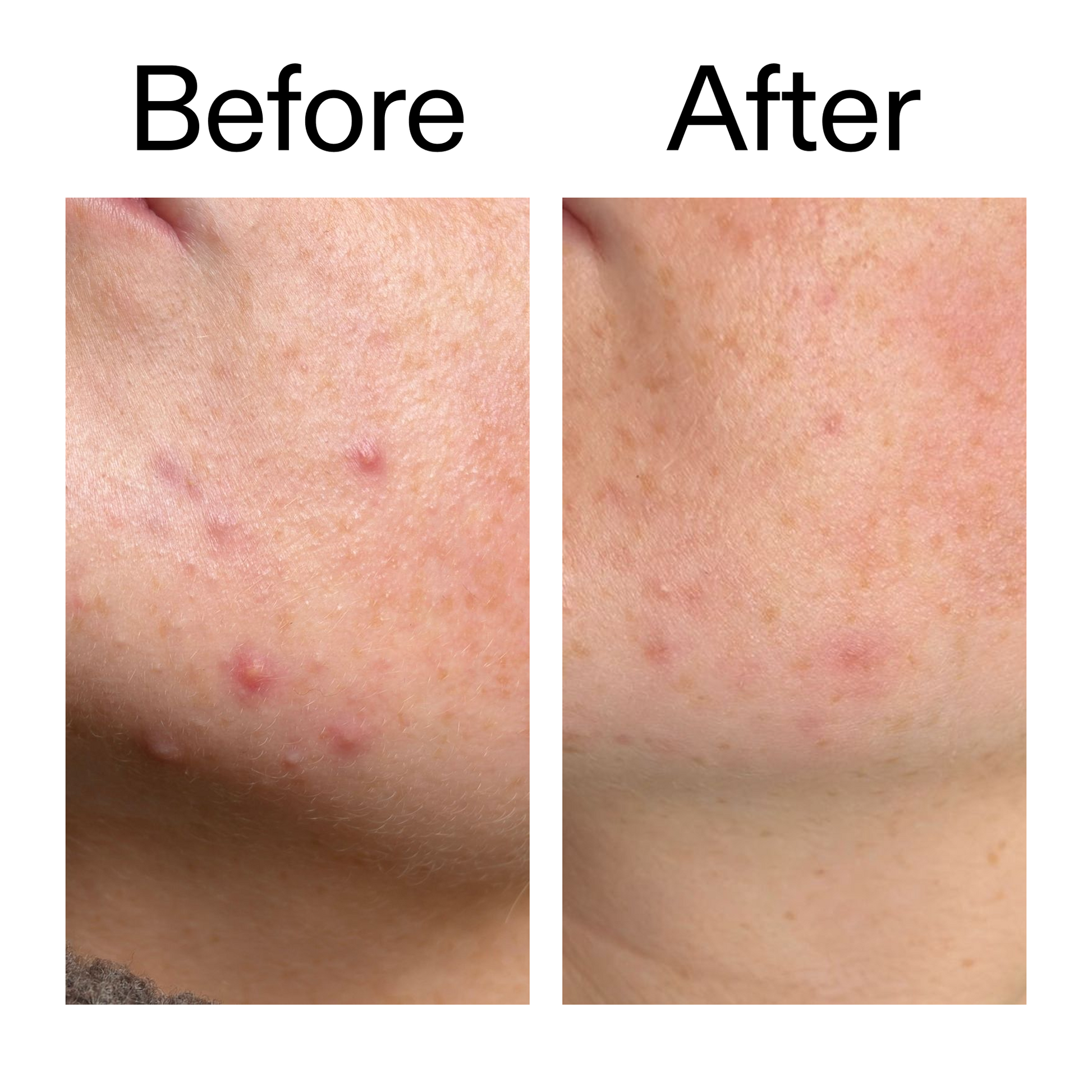 10-azelaic-acid-serum-for-redness-relief-g1 B_A_1_PPAGE.png