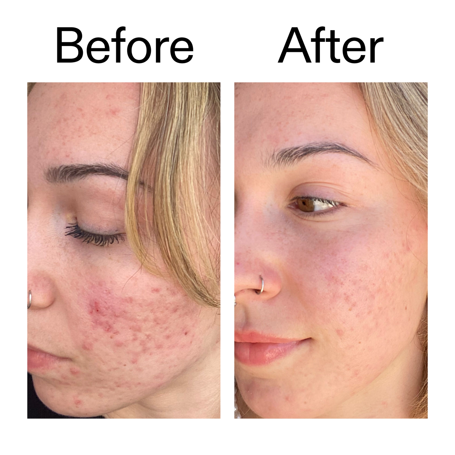 10-azelaic-acid-serum-for-redness-relief-g1 B_A_2_PPAGE.png