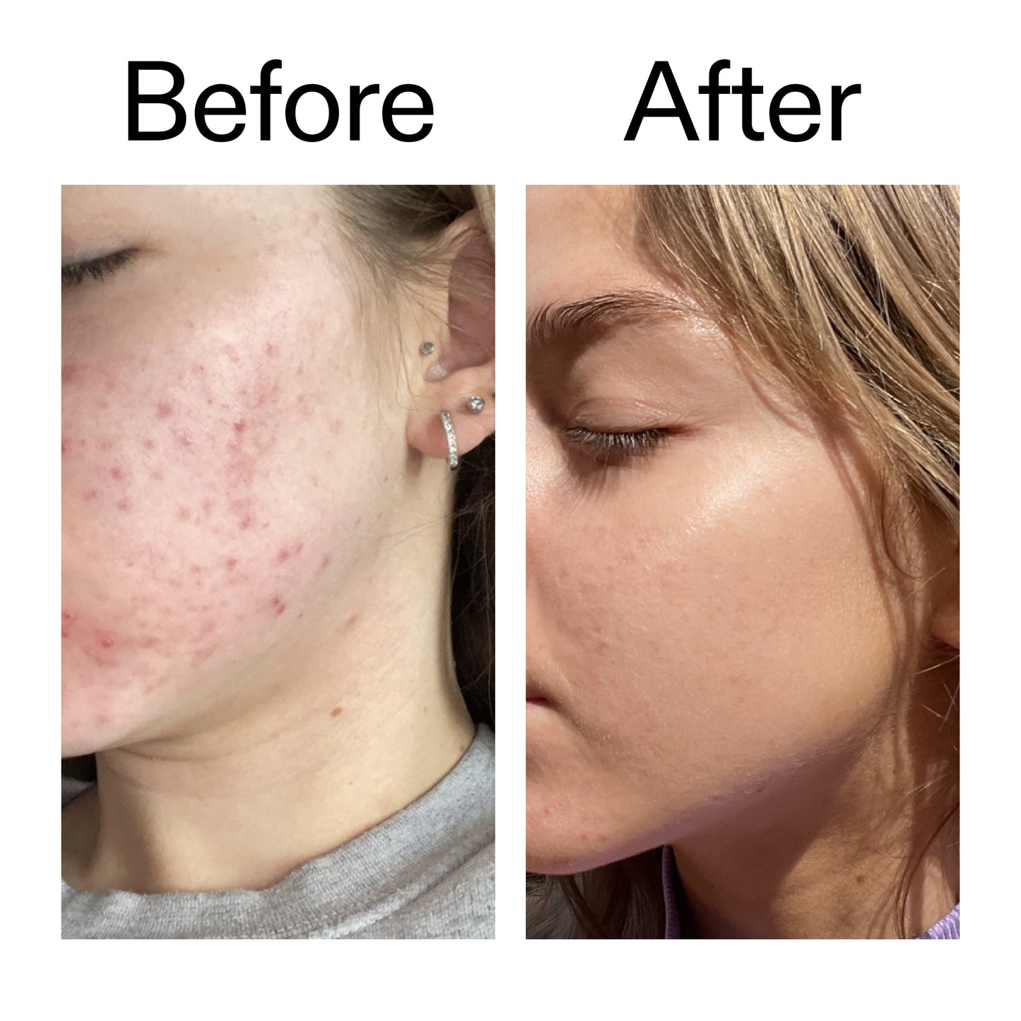beta-hydroxy-acid-bha-serum-u1 Beta_Hydroxy_Acid_Serum_Before_After_2000x2000_96fda3e5-938d-49ef-bcf2-a0fa6ece4e2c.jpg