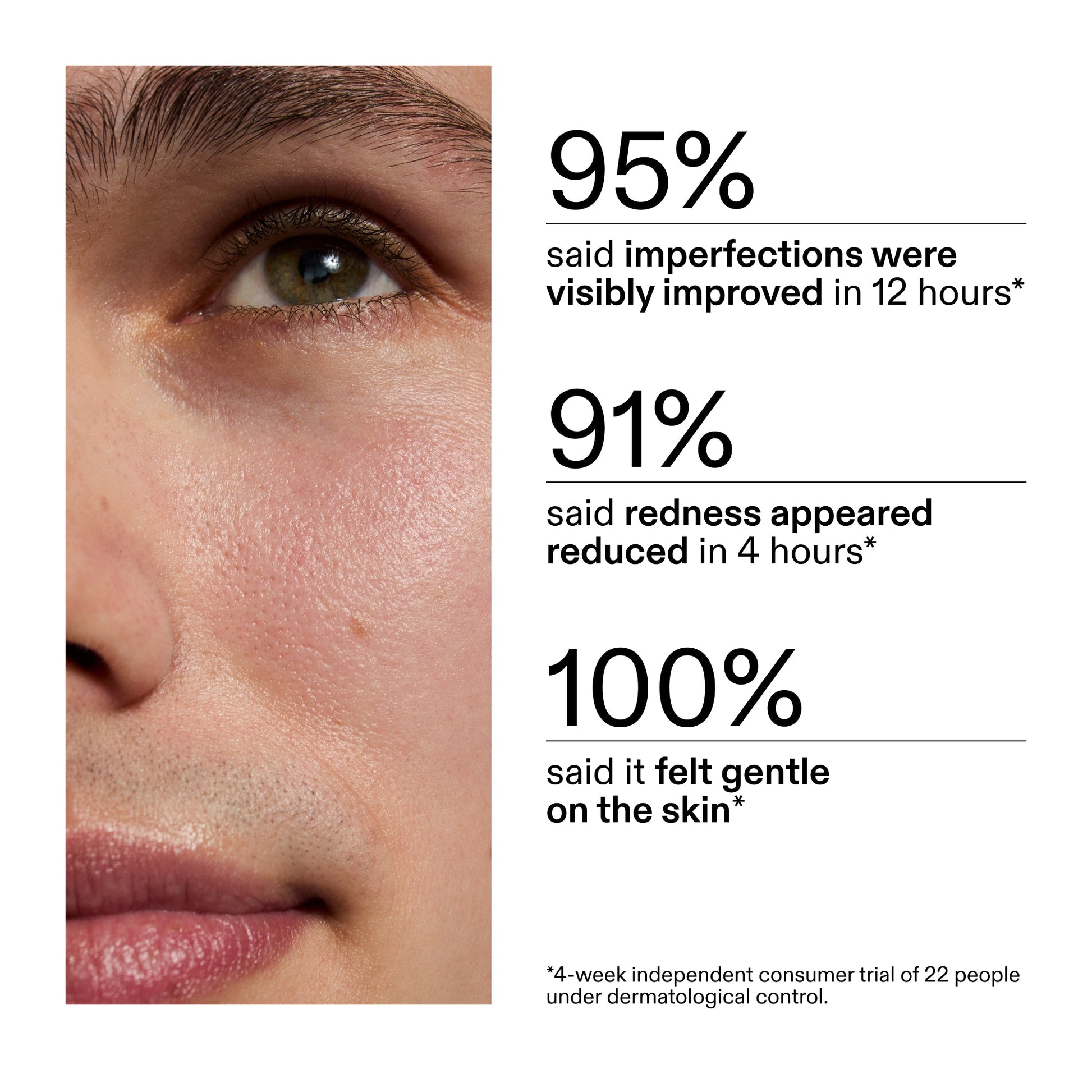 succinic-acid-acne-treatment-a8 CA_Succinic_Acid_Treatment_key_Claims_2000x2000_db91b0f1-7f29-4bfe-bb16-63a47f500960.jpg