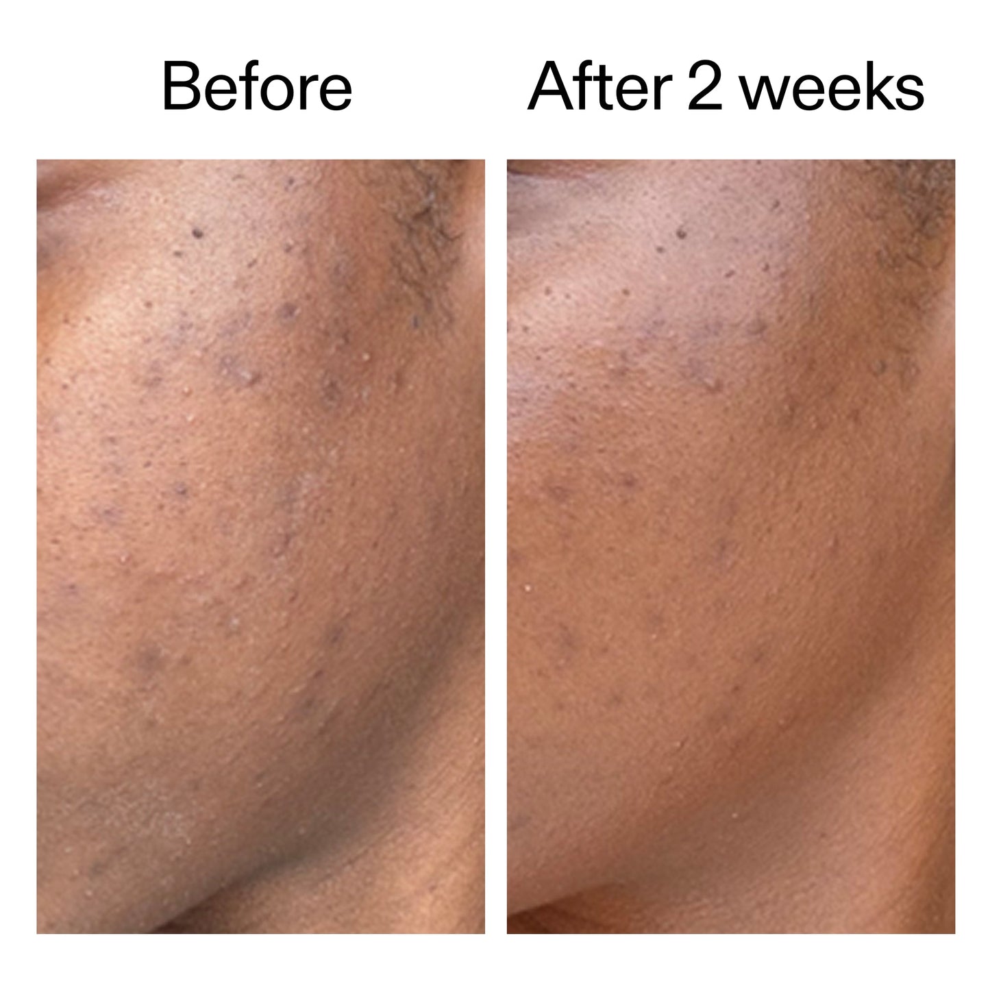 360-acne-clearing-duo-s2 DIOICB_A2000x2000.jpg