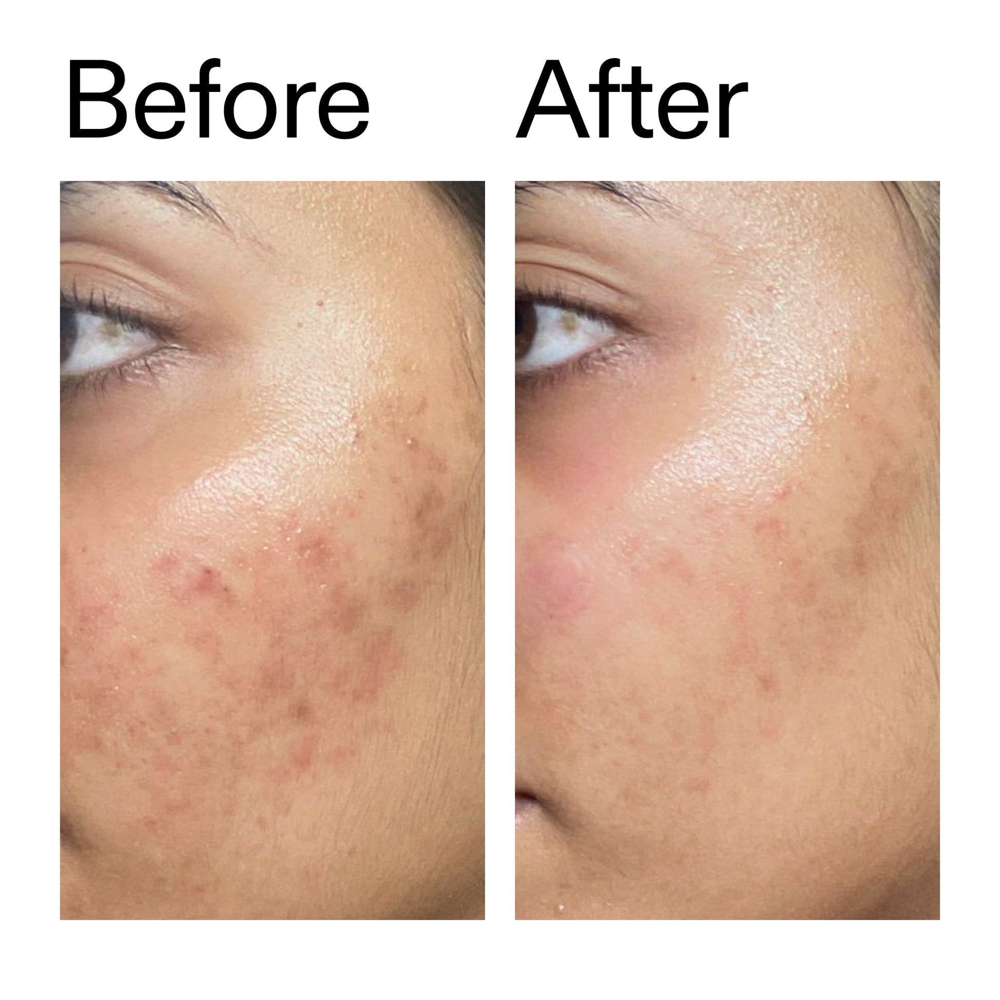 ectoin-hydro-barrier-serum-duo-u7 Ectoin_Hydro-barrier_Serum__Before_After_2000x2000_34261920-d004-48d0-9c7b-8e1c15971bfd.jpg