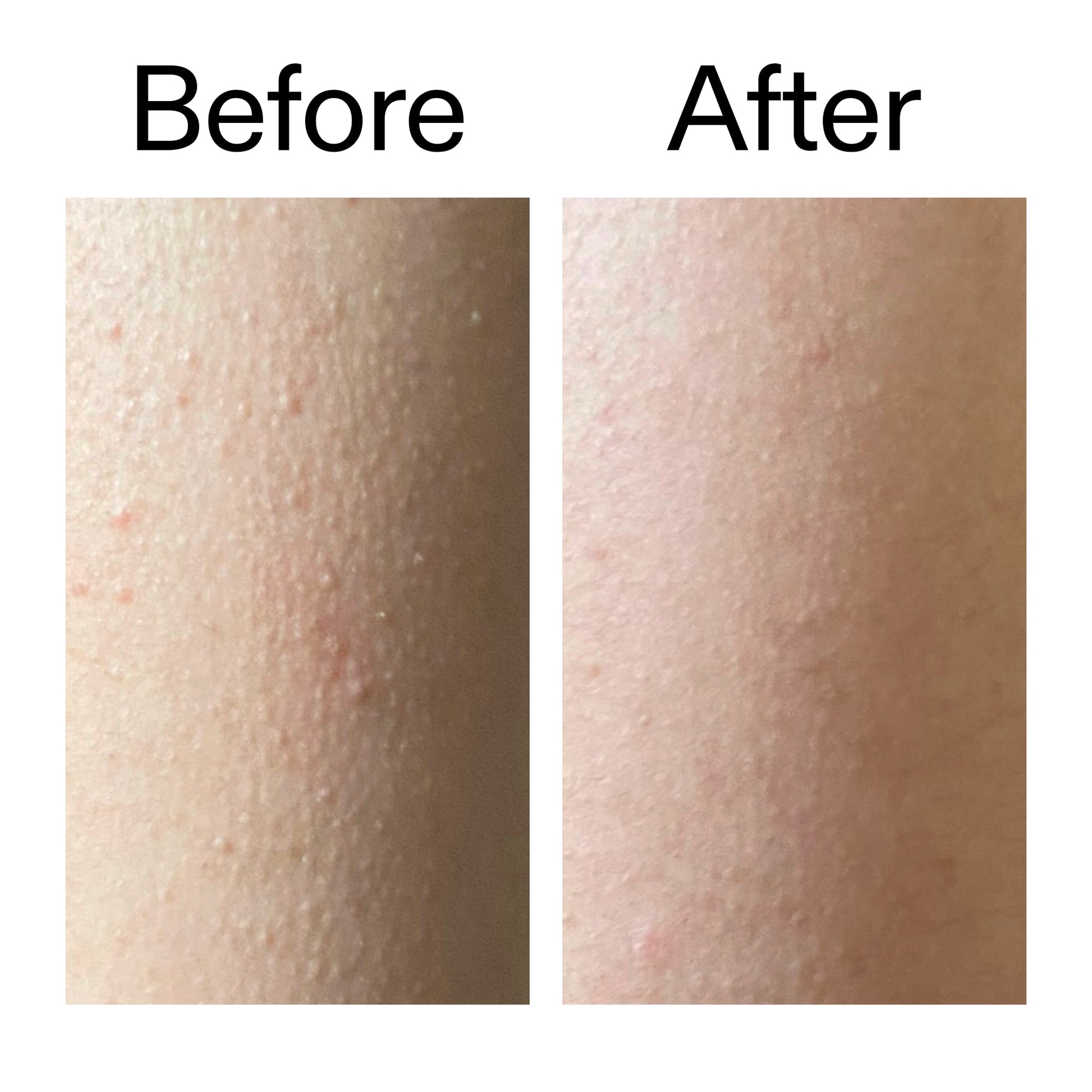glycolic-acid-exfoliating-body-stick-o5 Glycolic_Acid_Exfoliating_Body_Stick_Before_After_V2_2000x2000_2e4ba052-94f6-4d56-82df-7bdb5b2df7ae.jpg