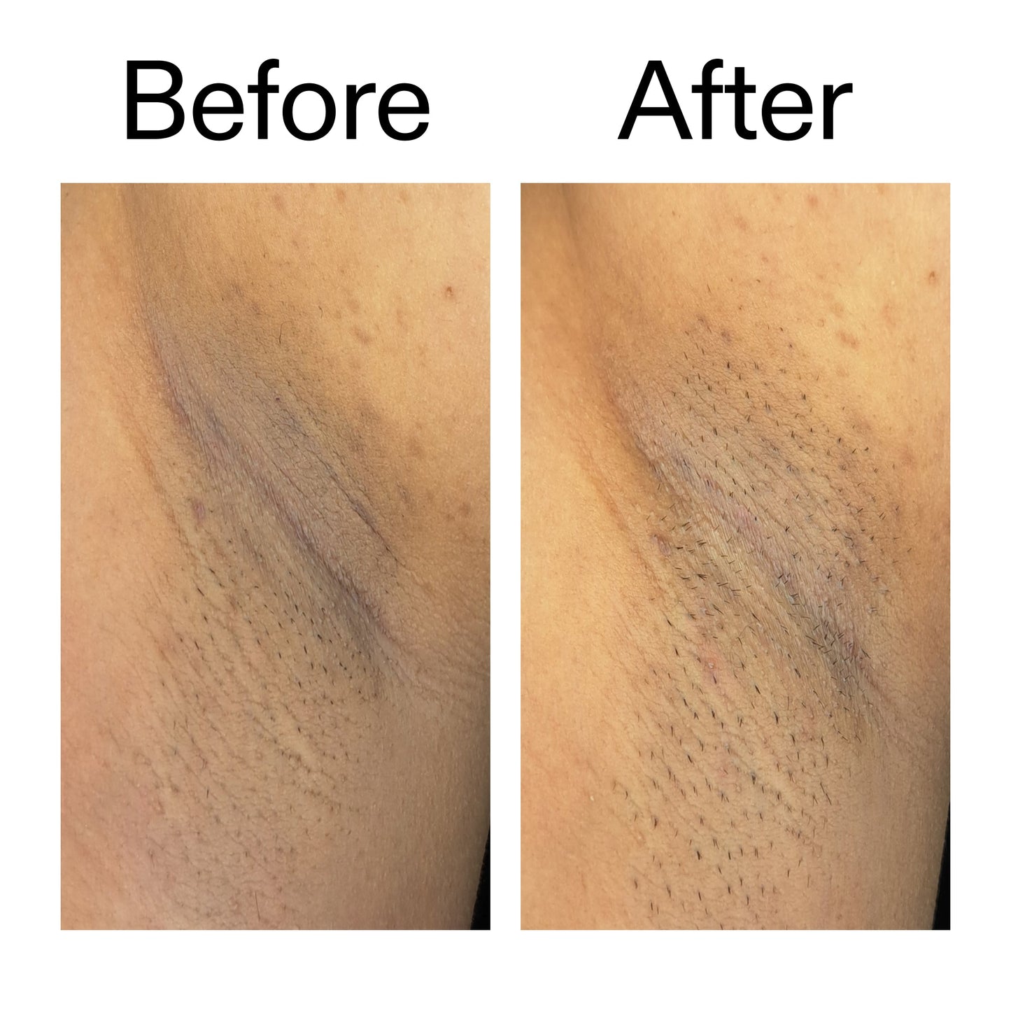 glycolic-acid-exfoliating-body-stick-duo-g6 Glycolic_Acid_Exfoliating_Body_Stick_Before_After_V3_2000x2000_ea919cd9-1439-4a46-82a0-76200eb5bb42.jpg
