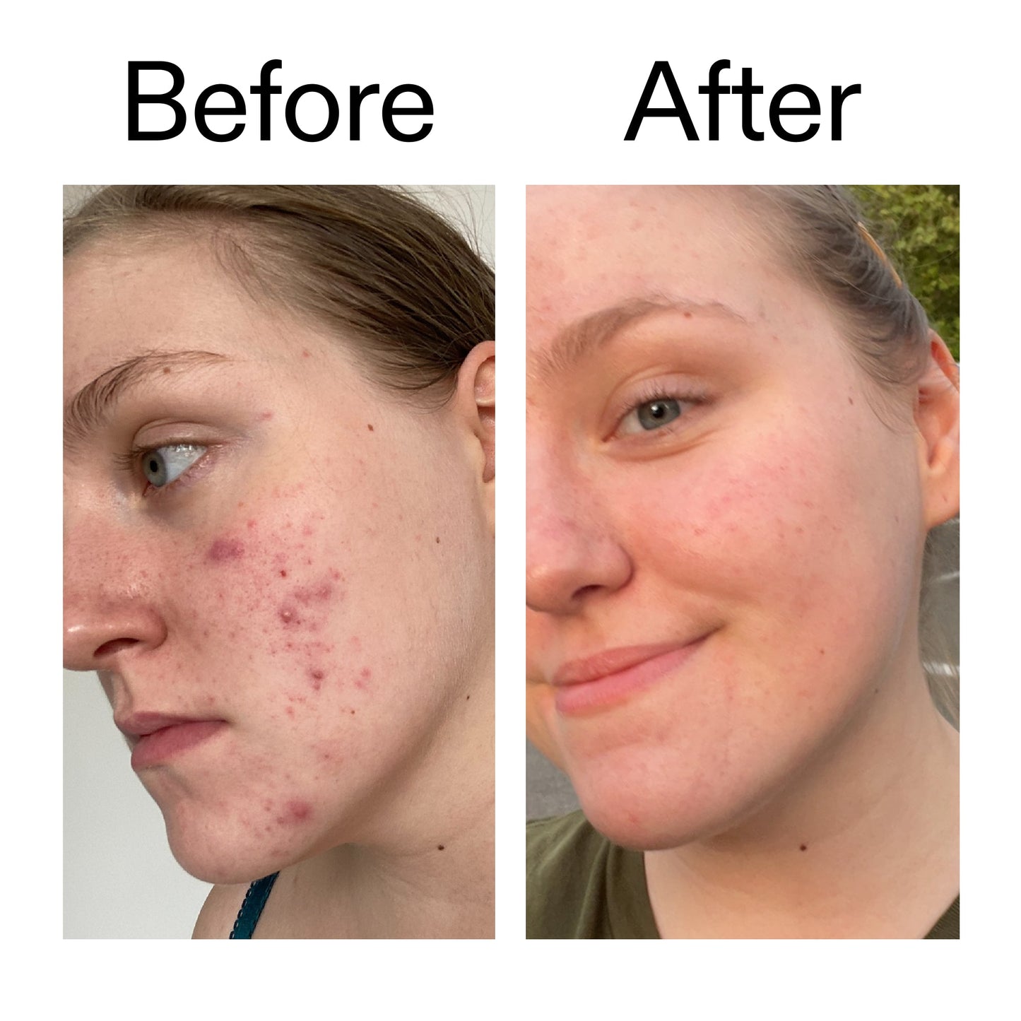 glycolic-acid-toner-e9 Glycolic_Acid_Toner_Before_After_2000x2000_49f0b9f7-e71b-4b2e-a8f8-2ea4b73247bb.jpg