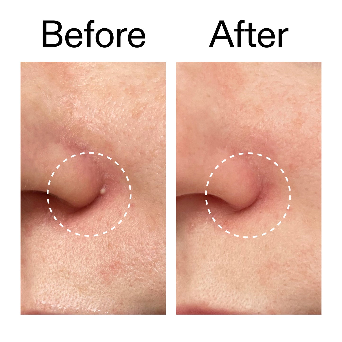 hydrocolloid-invisible-pimple-patches-pack-of-22-v5 Hydrocolloid_Invisible_Pimple_Patches_Before_After_2000x2000_b02aa37b-c78a-4682-91de-9135af5bb7df.jpg