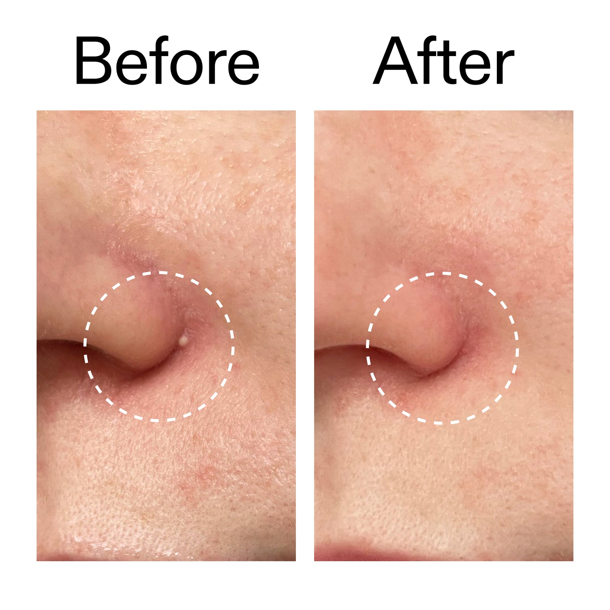 hydrocolloid-invisible-pimple-patches-pack-of-22-v5 Hydrocolloid_Invisible_Pimple_Patches_Before_After_2000x2000_b02aa37b-c78a-4682-91de-9135af5bb7df.jpg
