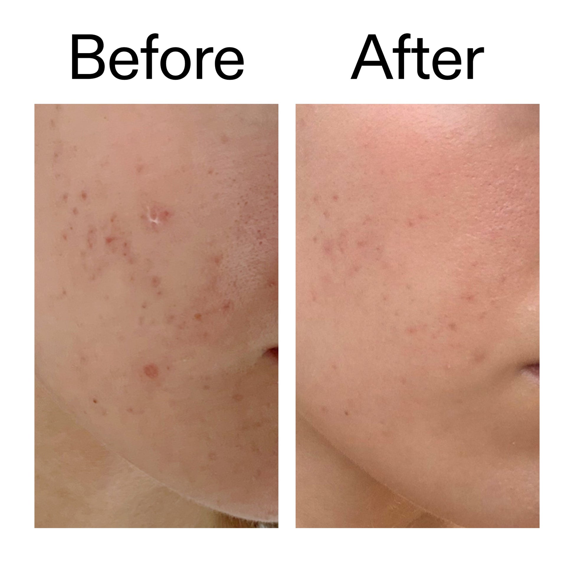 mandelic-acid-treatment-d4 Mandelic_Acid_Treatment_Before_After_2000x2000_4885ac6e-c5d7-4279-a72a-1417af7dce35.jpg