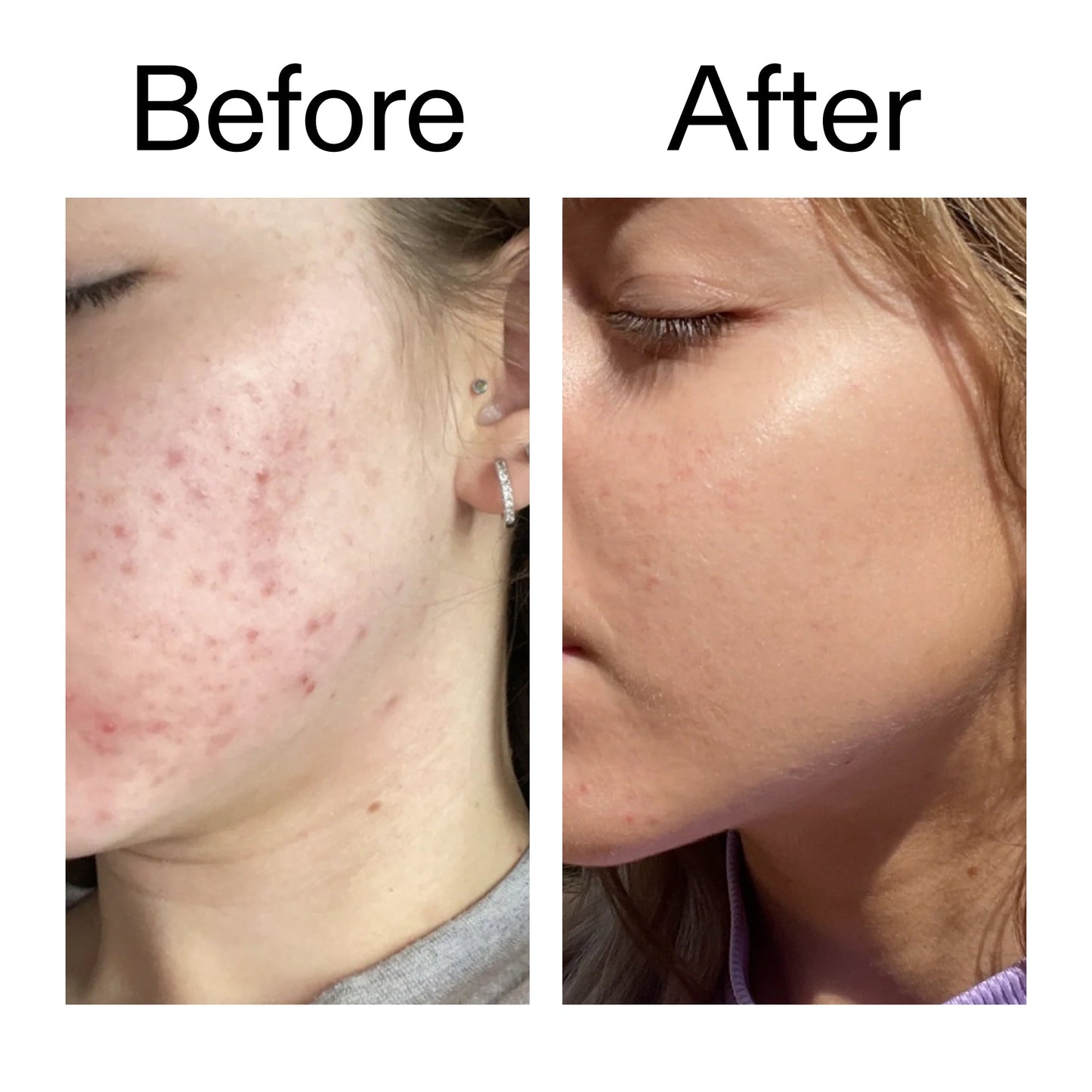 10-niacinamide-serum-duo-j5 Niacinamide_Serum_Before_After_2000x2000_bde32455-9e7d-448e-b053-bef41504f0a9.jpg