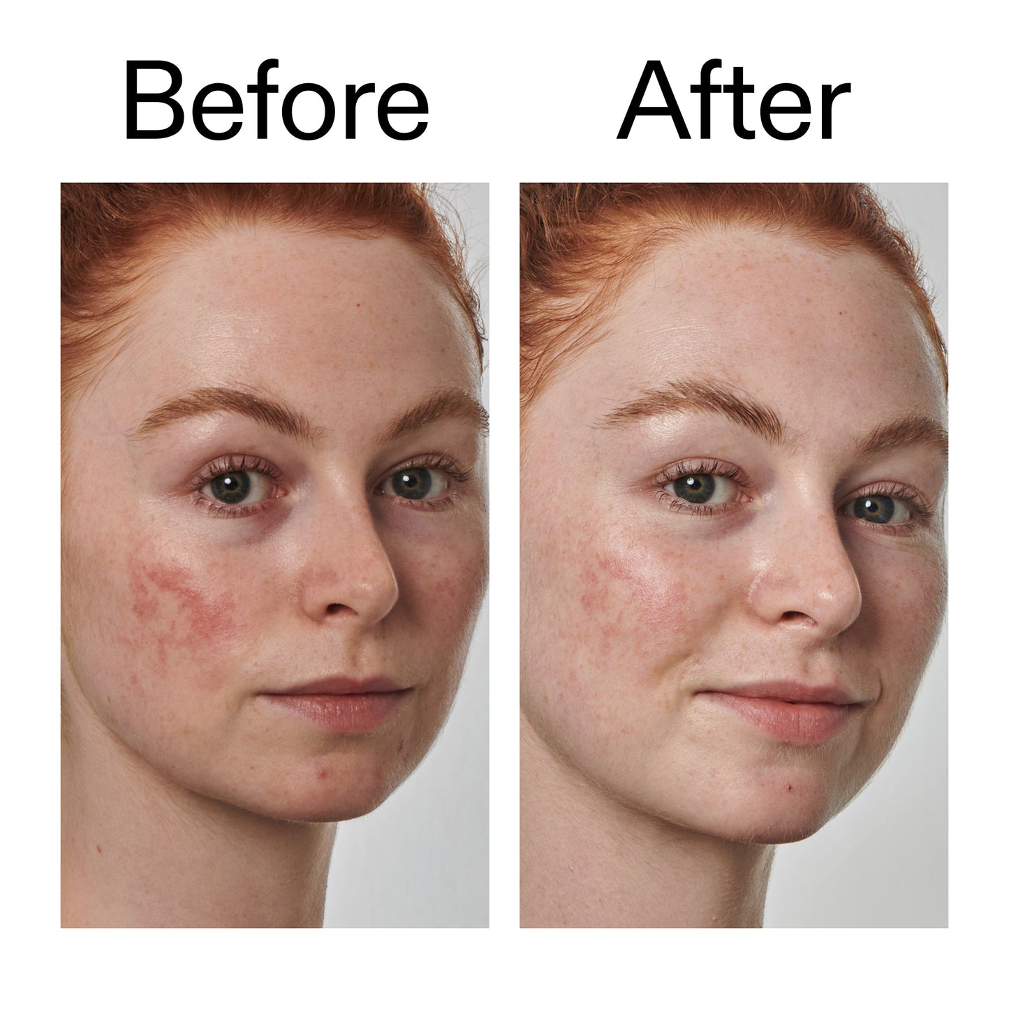 10-azelaic-acid-serum-for-redness-relief-g1 Redness_Relief_Serum_Before_After_2000x2000_3334dc9a-cce9-4e00-8aec-7ad89ca051f2.jpg