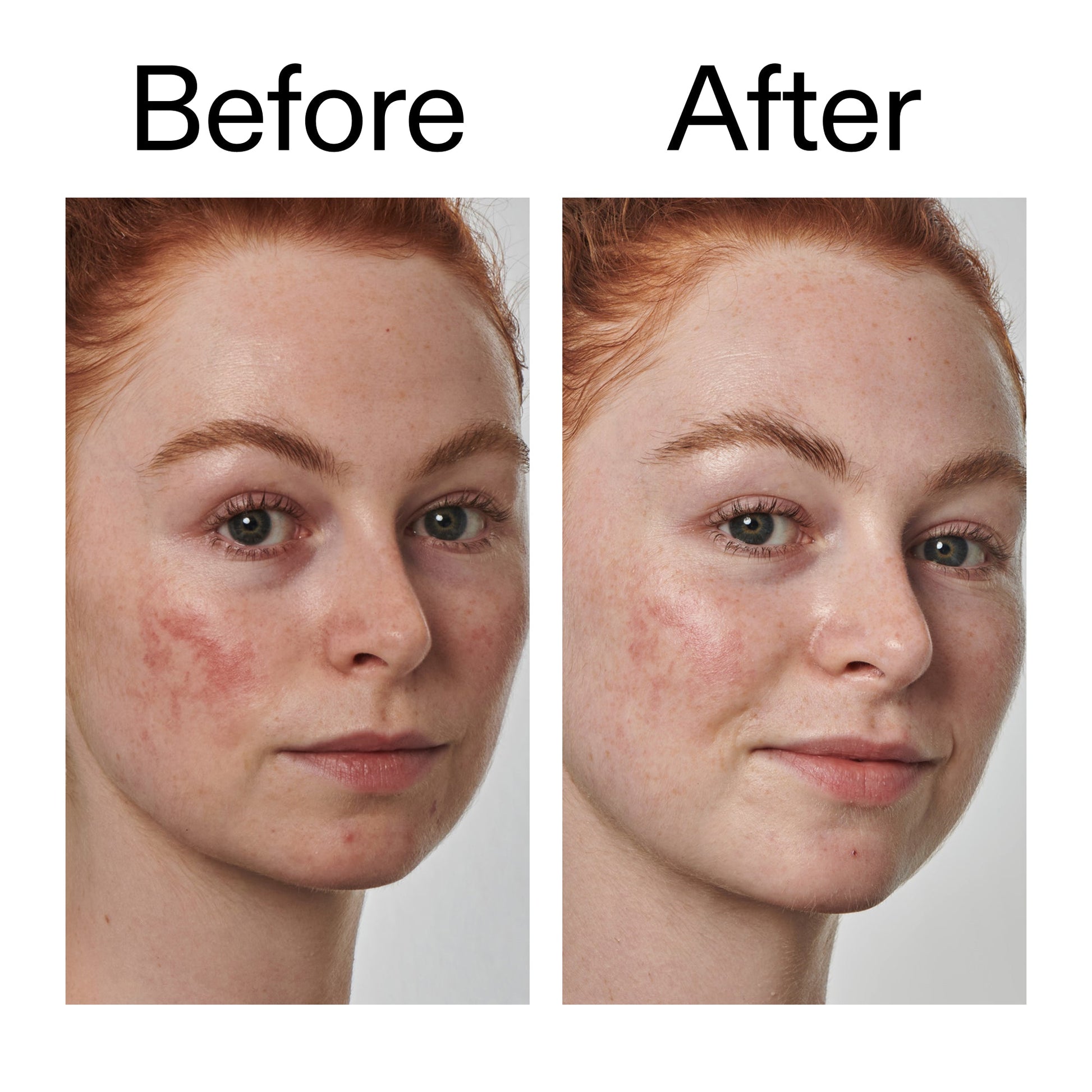 10-azelaic-acid-serum-for-redness-relief-g1 Redness_Relief_Serum_Before_After_2000x2000_3334dc9a-cce9-4e00-8aec-7ad89ca051f2.jpg
