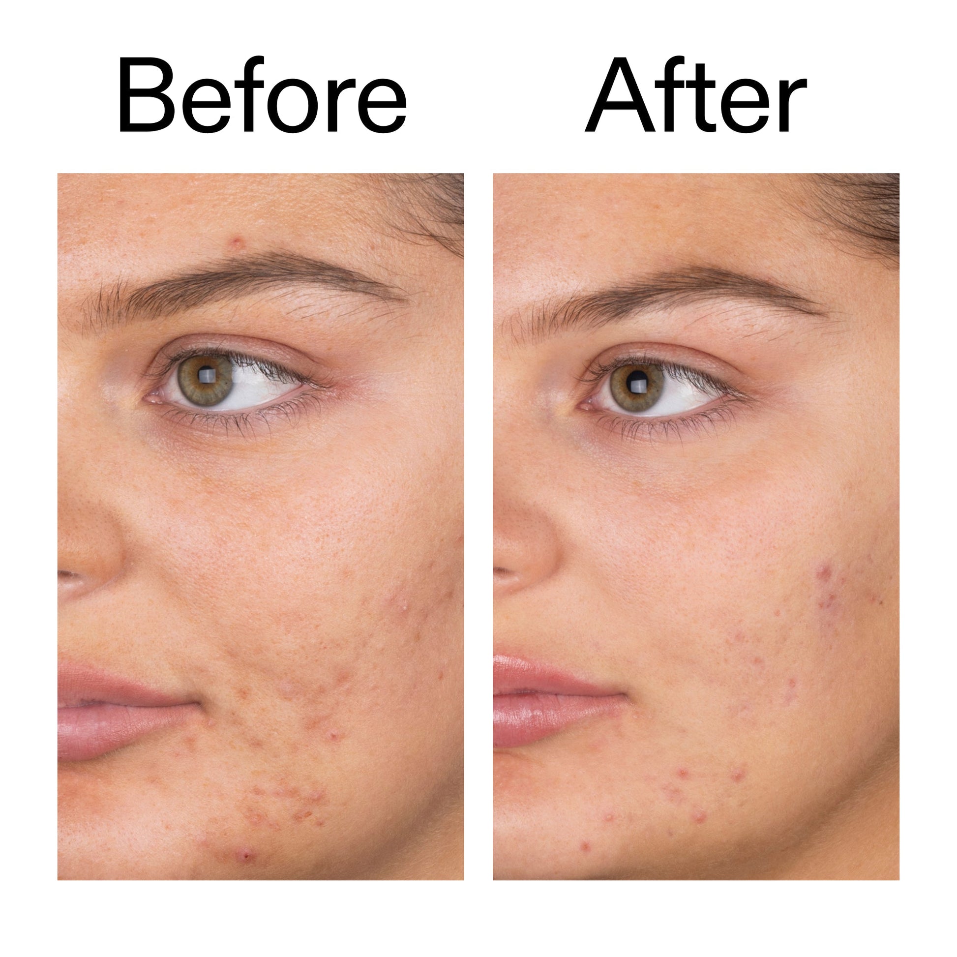 salicylic-acid-cleanser-150ml-s6 Salicylic_Acid_Cleanser_-_150ml_Before_After_2000x2000_e7230494-853f-4b07-82b1-27669104c995.jpg
