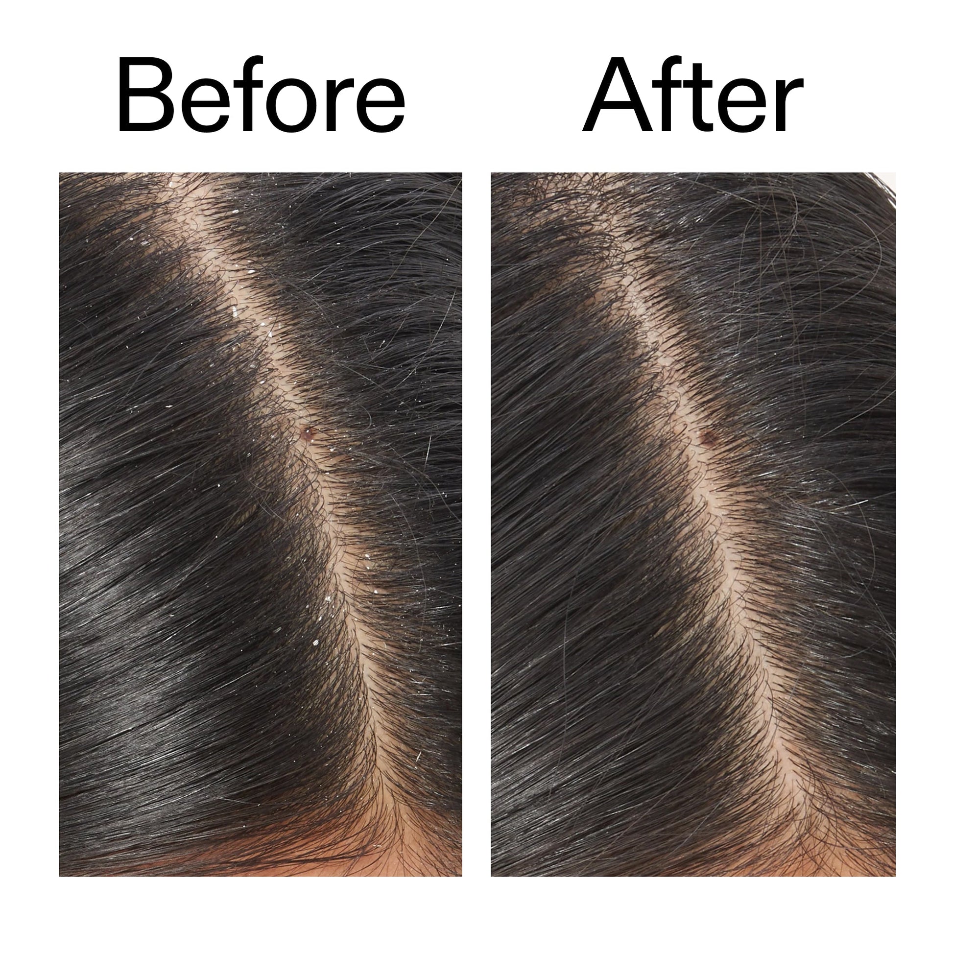 salicylic-acid-exfoliating-scalp-treatment-q9 Salicylic_Acid_Exfoliating_Scalp_Treatment_Before_After_V2_2000x2000_02bd61ad-42bf-490b-b3e3-7e04b2e8a673.jpg