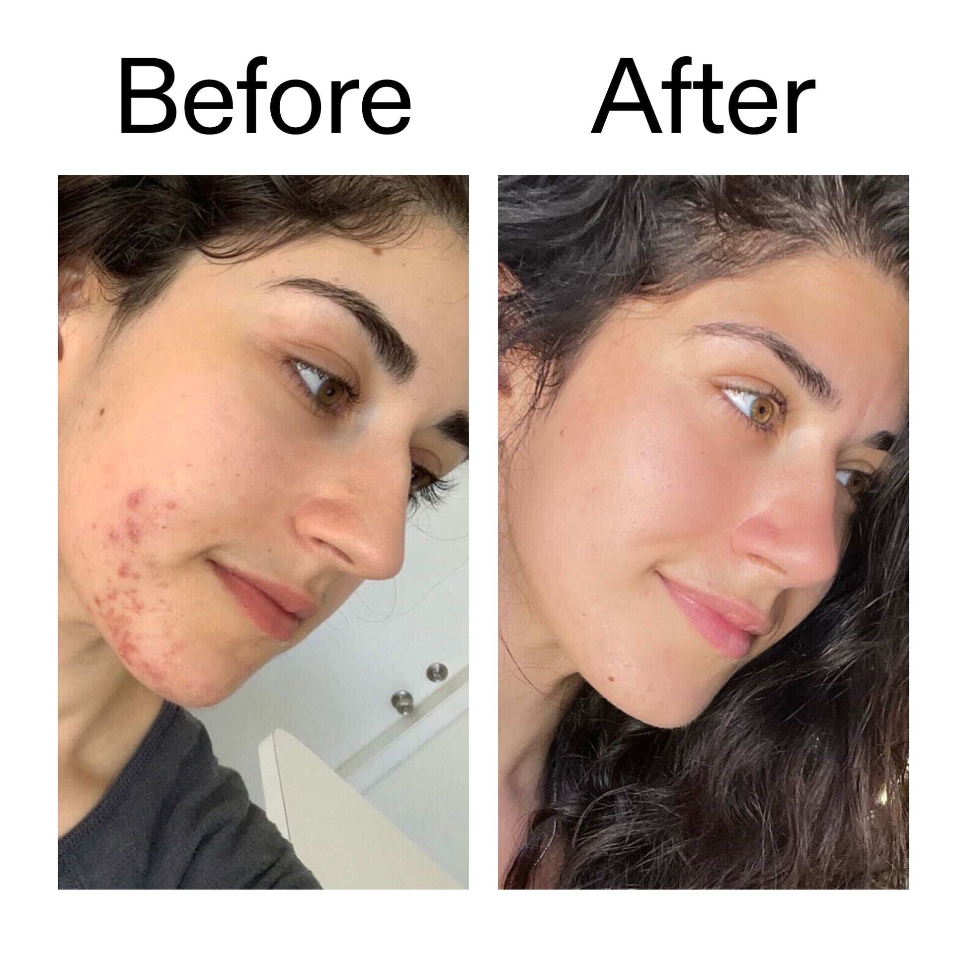 succinic-acid-acne-treatment-e1 Succinic_Acid_Treatment_Before_After_2000x2000_6a5f0054-2f58-4433-9314-0dc72c9bdd3b.jpg