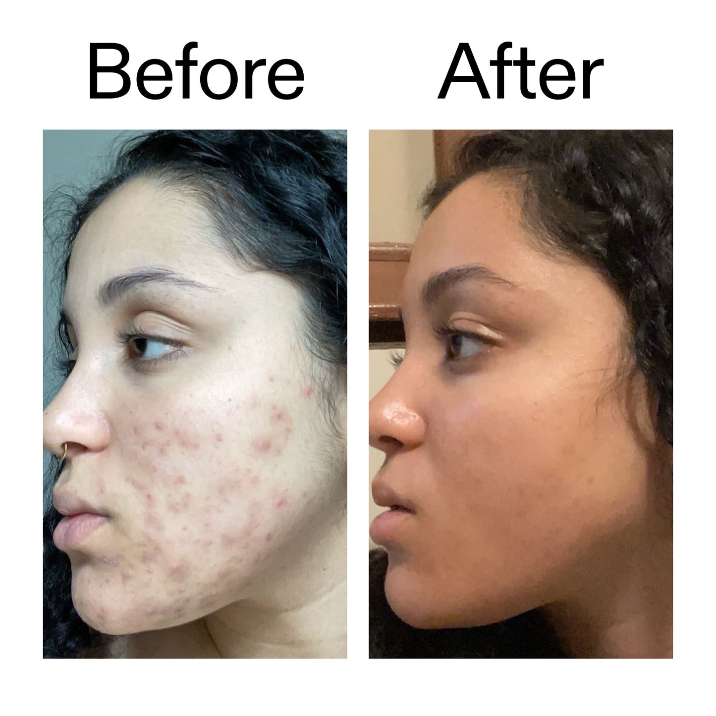 tranexamic-acid-serum-l6 Tranexamic_Acid_Serum_Before_After_2000x2000_98ebc8be-77b0-4843-8a22-90790ebe918b.jpg